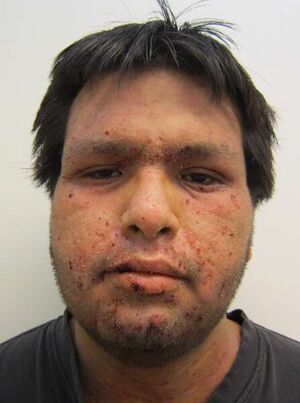 Impetigo2011.jpg