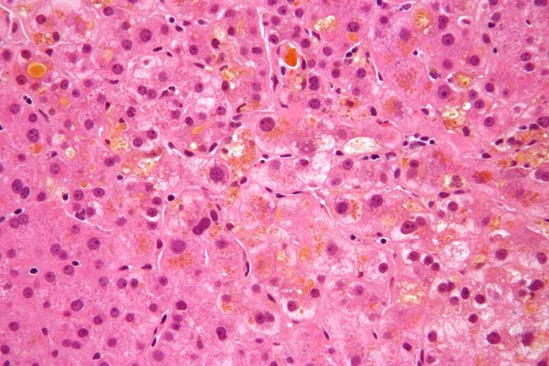 ملف:Cholestasis high mag.jpg