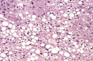 Liver steatosis fatty change.jpg