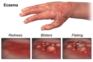 Eczema.png