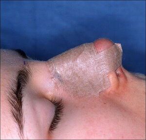 RhinoplastySplint4.jpg