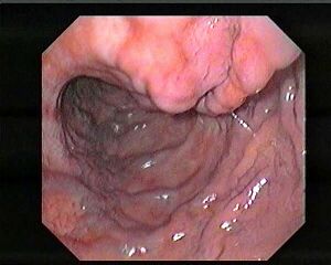 Gastric Varices.jpg