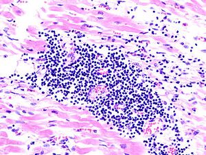 Viral myocarditis (1).JPG