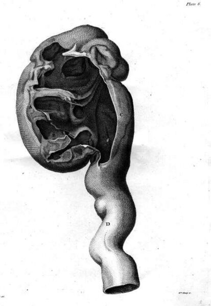 ملف:Hunter enlarged kidney.jpg