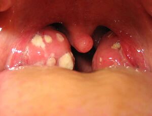 Tonsillitis.jpg