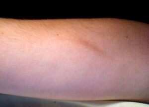Very-minor-scar.jpg
