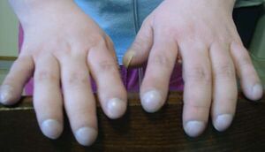 ClubbingFingers1.jpg