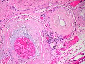 Amyloidosis, blood vessels, H&E.jpg