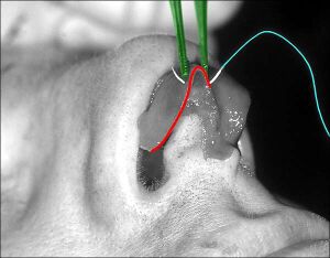 RhinoplastyNarrowTip.jpg